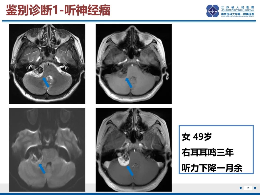 影像PPT - 【PPT】岩尖胆脂瘤-32