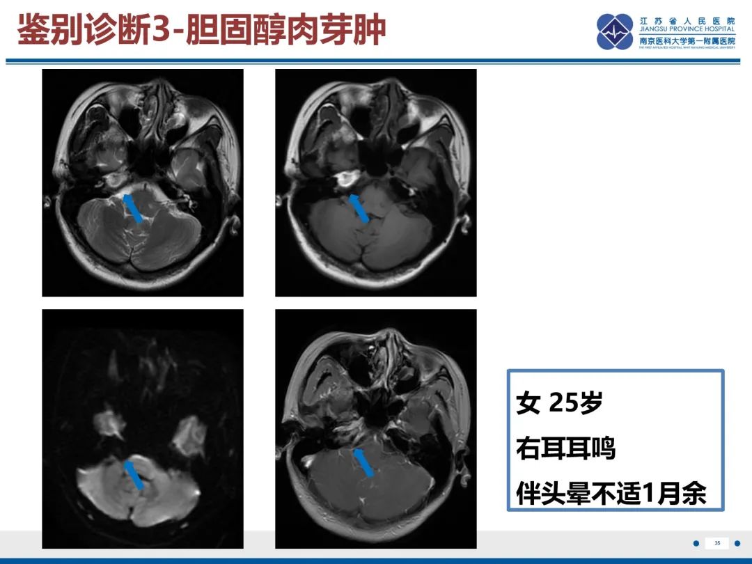 影像PPT - 【PPT】岩尖胆脂瘤-36