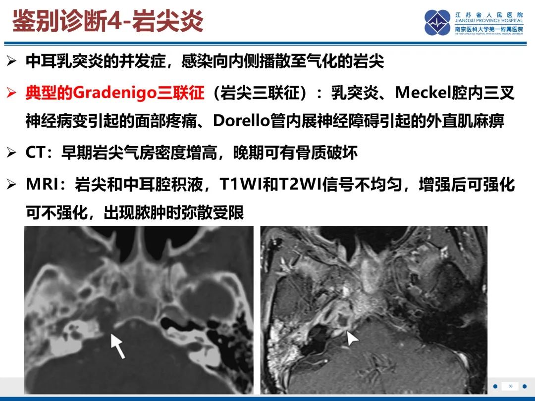 影像PPT - 【PPT】岩尖胆脂瘤-37