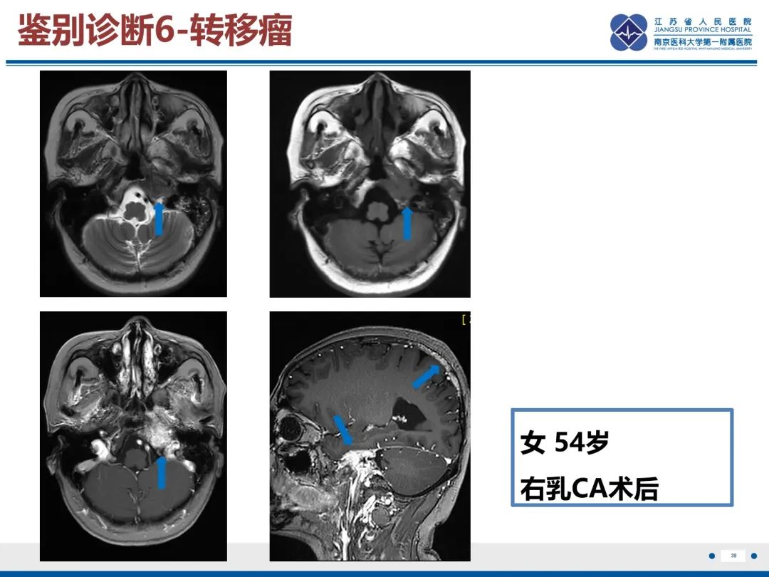 影像PPT - 【PPT】岩尖胆脂瘤-40