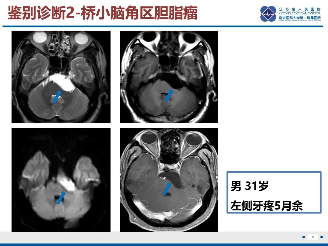 影像PPT - 【PPT】岩尖胆脂瘤-34