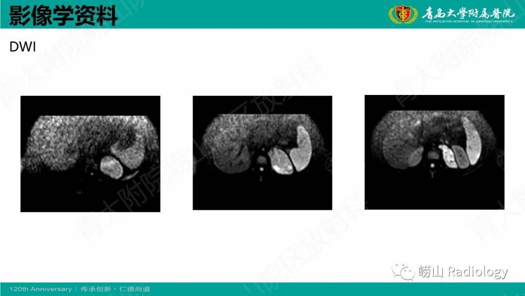 影像PPT - 【病例】腹膜后节细胞神经母细胞瘤1例CT影像-12