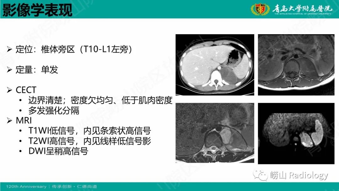 影像PPT - 【病例】腹膜后节细胞神经母细胞瘤1例CT影像-15
