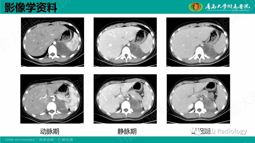 影像PPT - 【病例】腹膜后节细胞神经母细胞瘤1例CT影像-7
