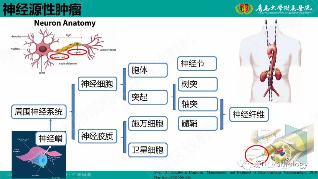 影像PPT - 【病例】腹膜后节细胞神经母细胞瘤1例CT影像-17