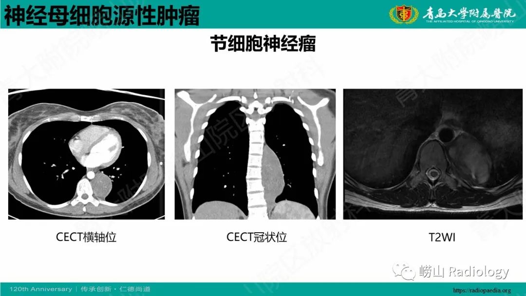 影像PPT - 【病例】腹膜后节细胞神经母细胞瘤1例CT影像-21
