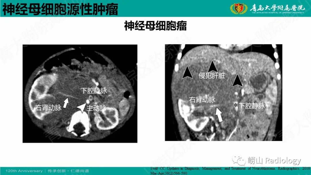 影像PPT - 【病例】腹膜后节细胞神经母细胞瘤1例CT影像-23