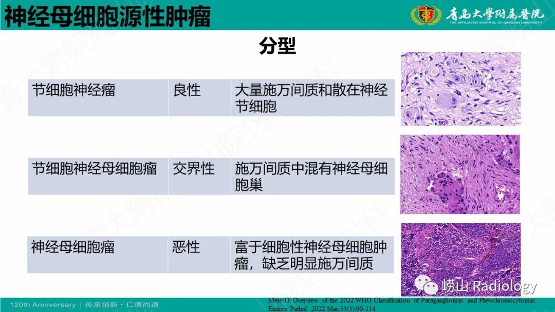 影像PPT - 【病例】腹膜后节细胞神经母细胞瘤1例CT影像-19