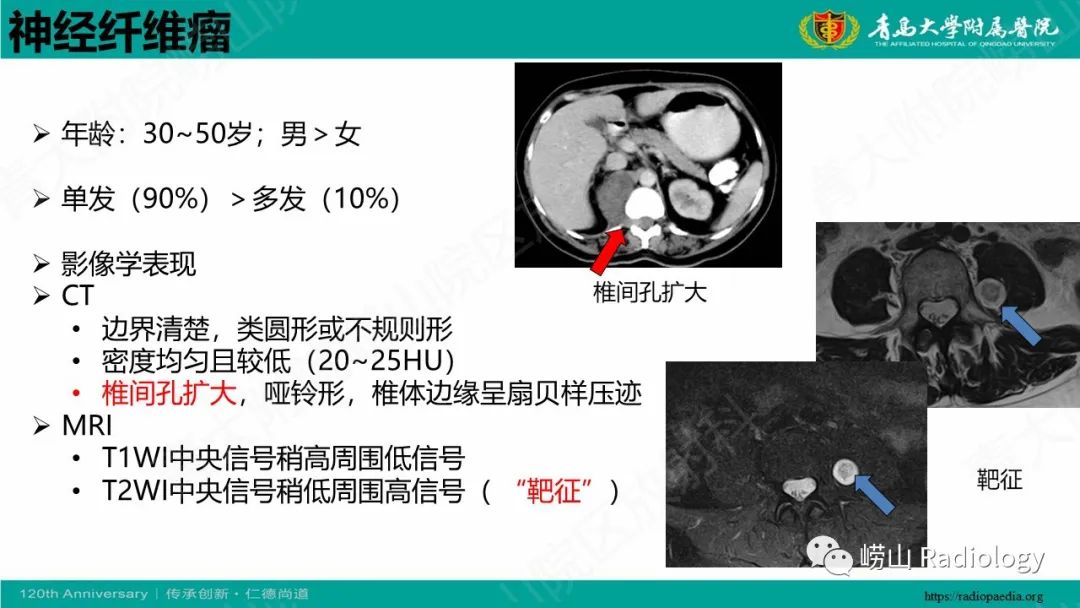 影像PPT - 【病例】腹膜后节细胞神经母细胞瘤1例CT影像-30
