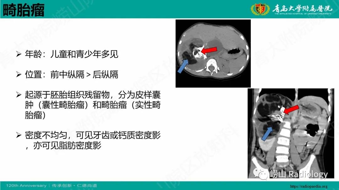 影像PPT - 【病例】腹膜后节细胞神经母细胞瘤1例CT影像-32