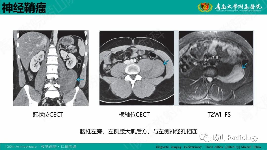 影像PPT - 【病例】腹膜后节细胞神经母细胞瘤1例CT影像-29