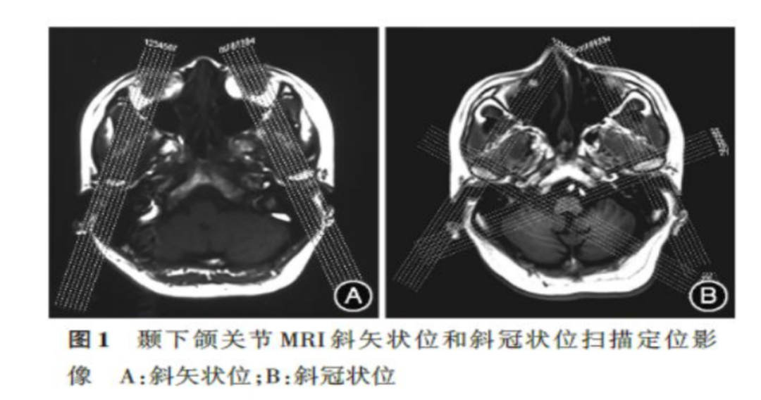 影像PPT - 颞下颌关节紊乱病-4 影像PPT - 颞下颌关节紊乱病-4