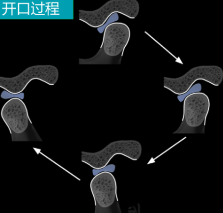影像PPT - 颞下颌关节紊乱病-8 影像PPT - 颞下颌关节紊乱病-8