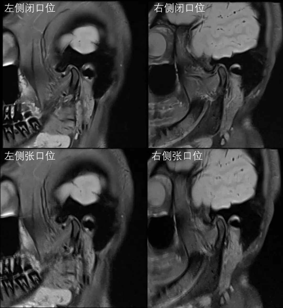 影像PPT - 颞下颌关节紊乱病-1 影像PPT - 颞下颌关节紊乱病-1