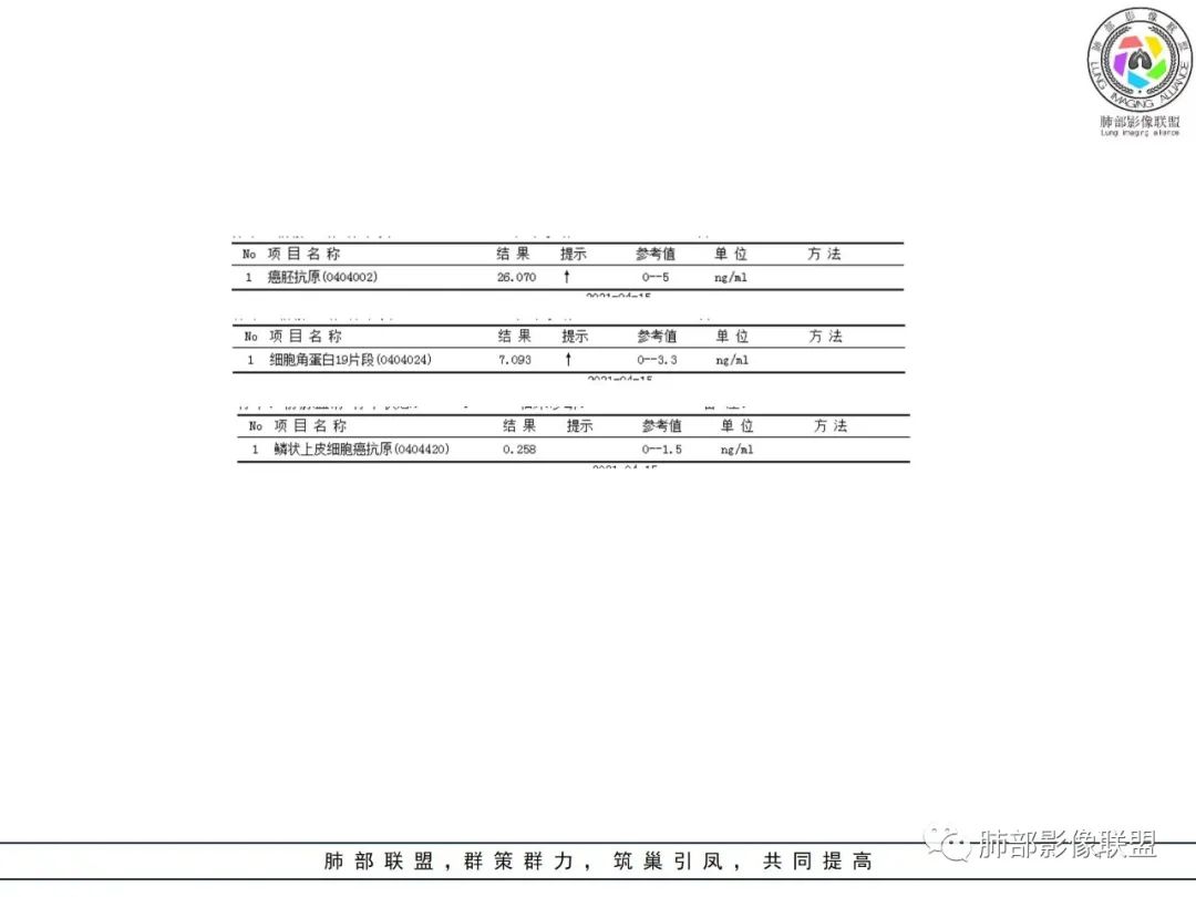 影像PPT - 【病例】肺大细胞神经内分泌癌1例CT影像-4 影像PPT - 【病例】肺大细胞神经内分泌癌1例CT影像-4