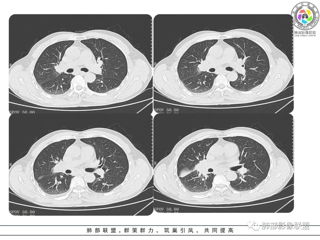 影像PPT - 【病例】肺大细胞神经内分泌癌1例CT影像-10 影像PPT - 【病例】肺大细胞神经内分泌癌1例CT影像-10