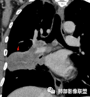影像PPT - 【病例】肺大细胞神经内分泌癌1例CT影像-23 影像PPT - 【病例】肺大细胞神经内分泌癌1例CT影像-23