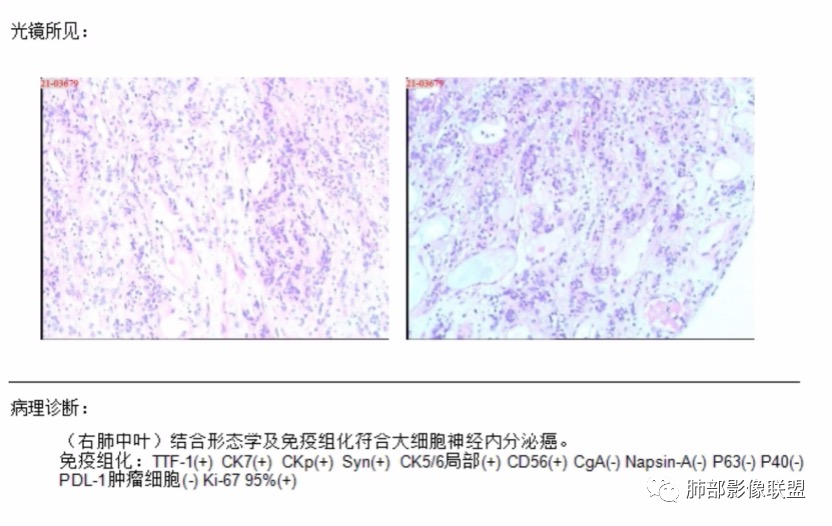 影像PPT - 【病例】肺大细胞神经内分泌癌1例CT影像-24 影像PPT - 【病例】肺大细胞神经内分泌癌1例CT影像-24