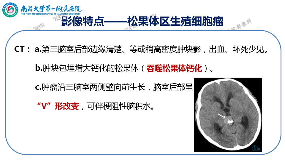 影像PPT - 【PPT】颅内生殖细胞瘤-40