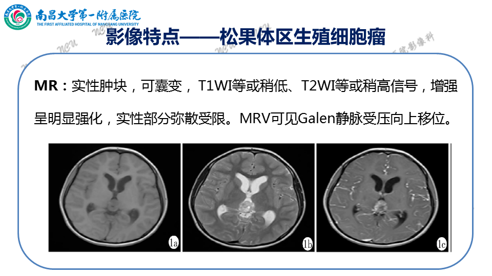 影像PPT - 【PPT】颅内生殖细胞瘤-41