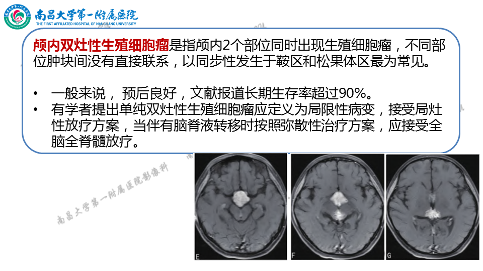 影像PPT - 【PPT】颅内生殖细胞瘤-42