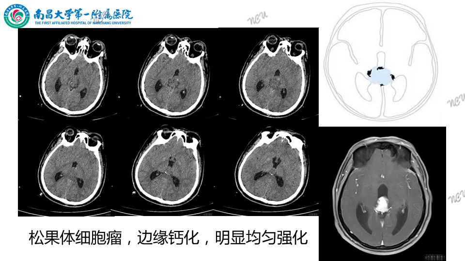 影像PPT - 【PPT】颅内生殖细胞瘤-45