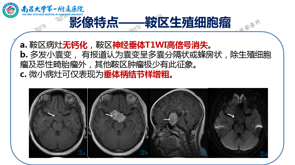 影像PPT - 【PPT】颅内生殖细胞瘤-49