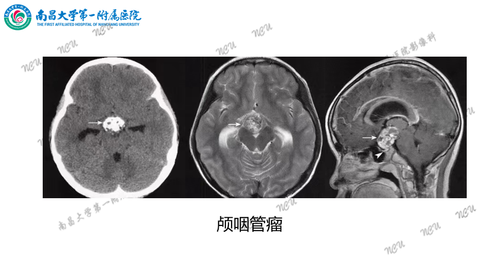 影像PPT - 【PPT】颅内生殖细胞瘤-51