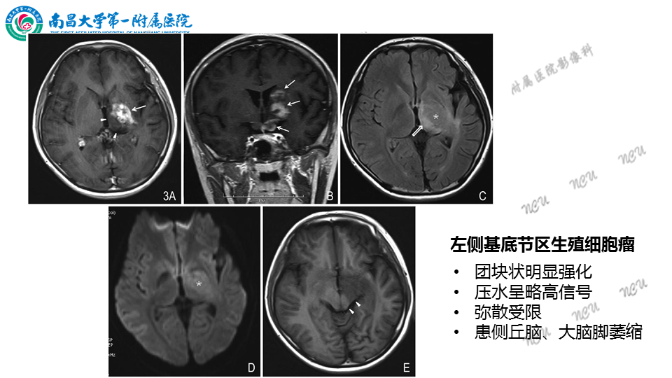 影像PPT - 【PPT】颅内生殖细胞瘤-55