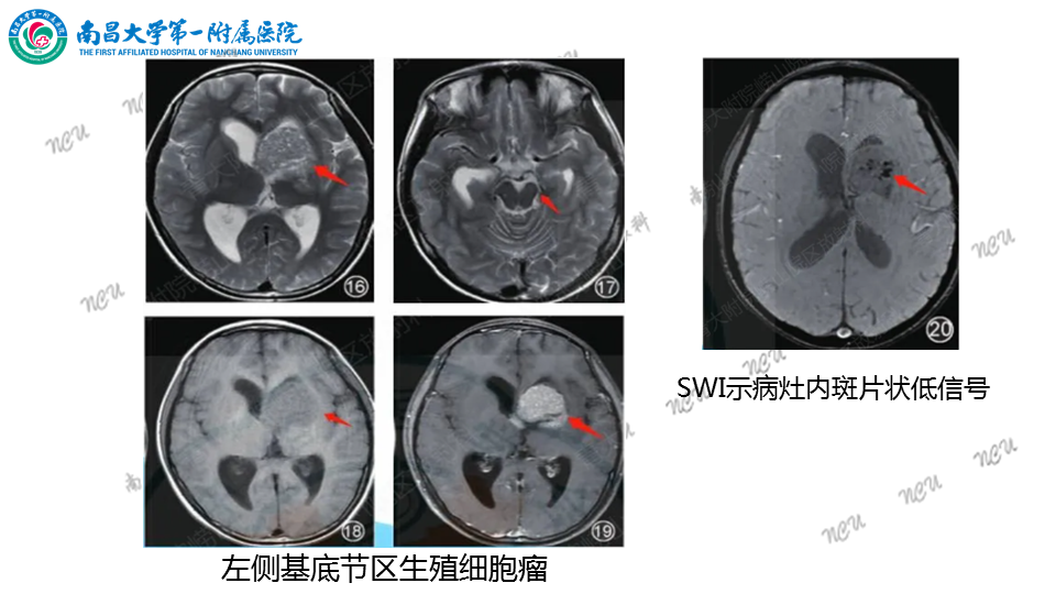 影像PPT - 【PPT】颅内生殖细胞瘤-57