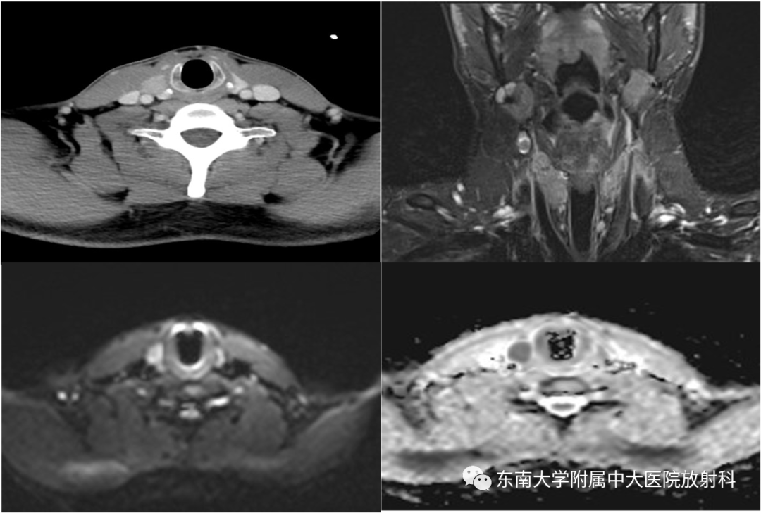 影像PPT - 【PPT】甲状腺癌的影像诊断-1