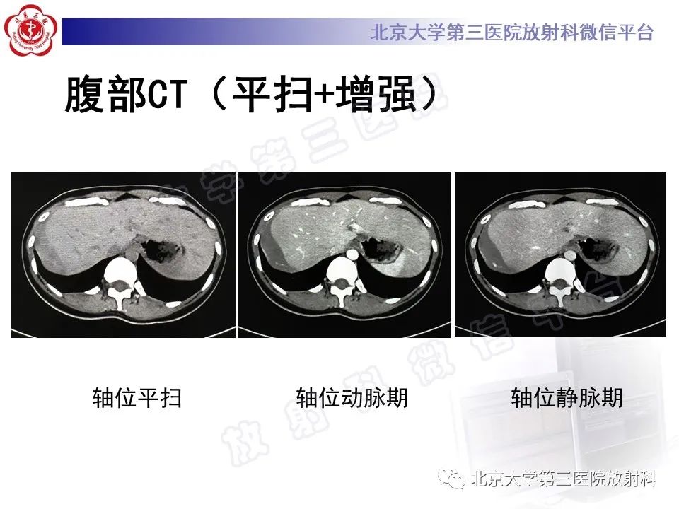 影像PPT - 【PPT】膈下异位妊娠-3