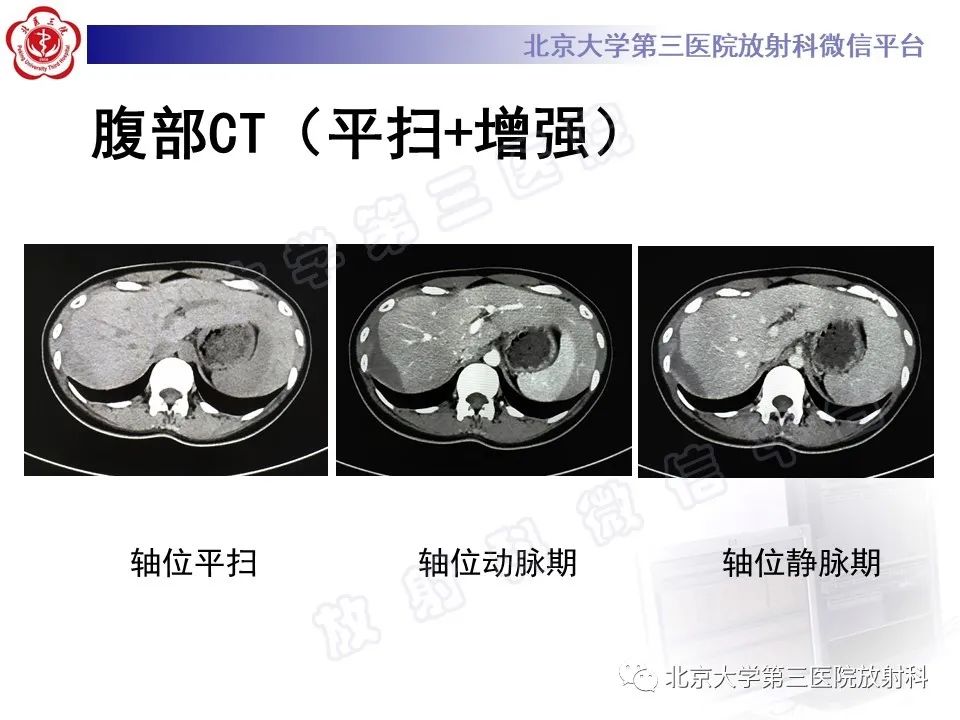 影像PPT - 【PPT】膈下异位妊娠-4