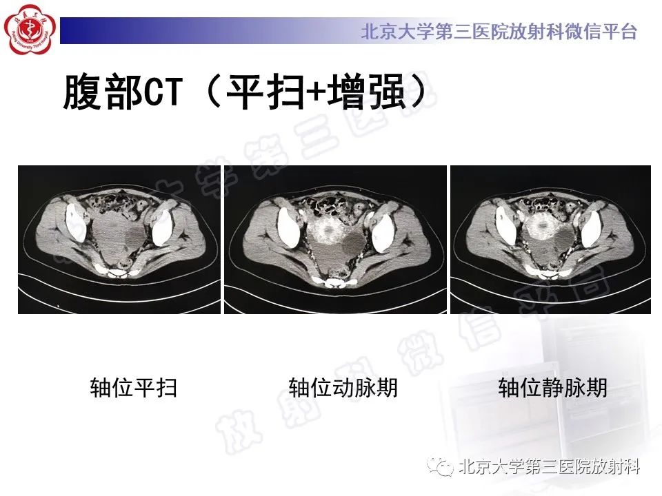 影像PPT - 【PPT】膈下异位妊娠-5