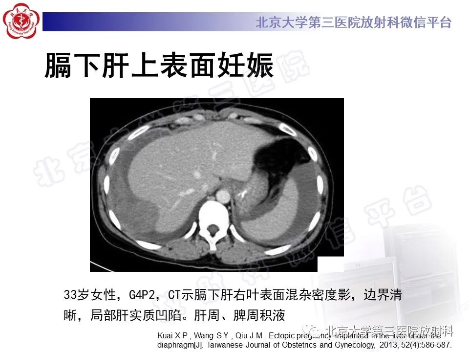 影像PPT - 【PPT】膈下异位妊娠-16