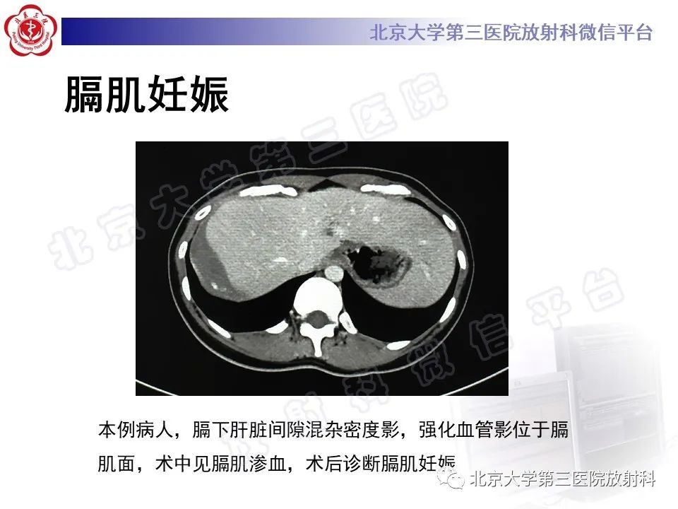 影像PPT - 【PPT】膈下异位妊娠-15