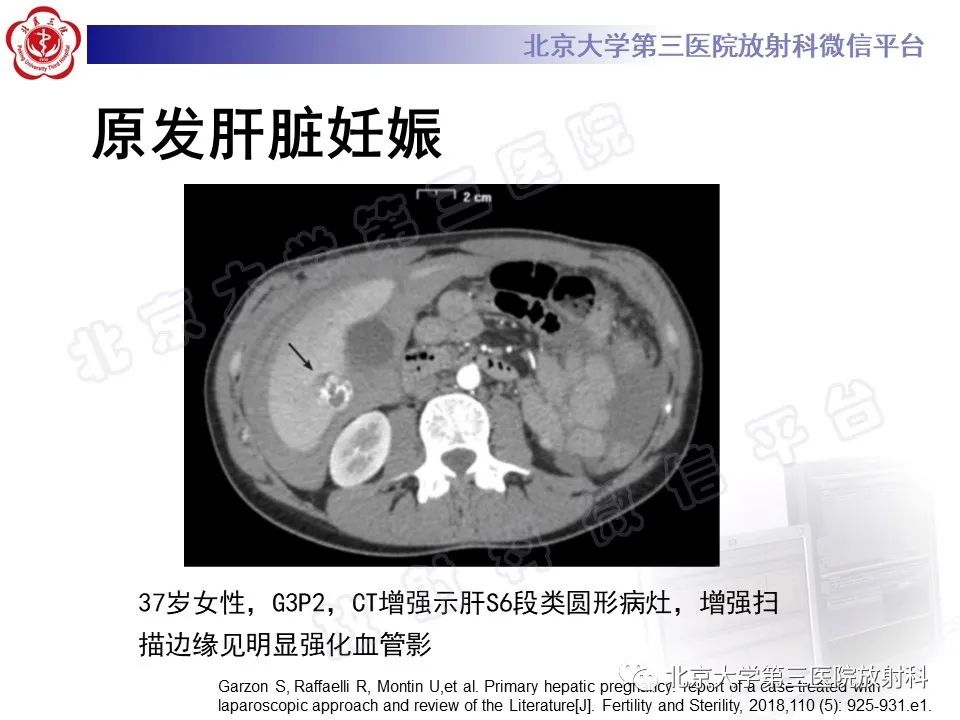 影像PPT - 【PPT】膈下异位妊娠-17