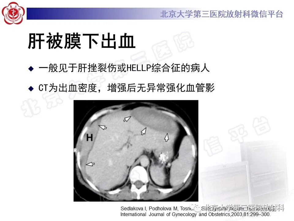 影像PPT - 【PPT】膈下异位妊娠-19