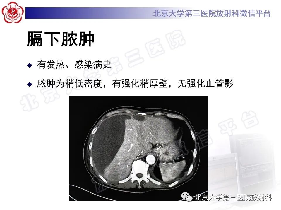 影像PPT - 【PPT】膈下异位妊娠-20