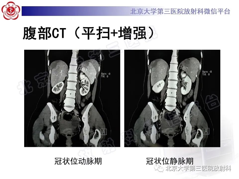 影像PPT - 【PPT】膈下异位妊娠-6