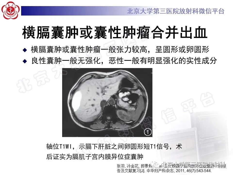 影像PPT - 【PPT】膈下异位妊娠-22