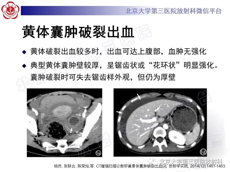 影像PPT - 【PPT】膈下异位妊娠-1