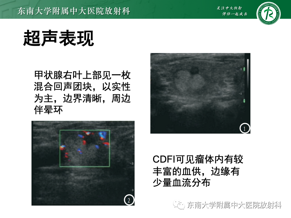 影像PPT - 【PPT】甲状腺癌的影像诊断-10
