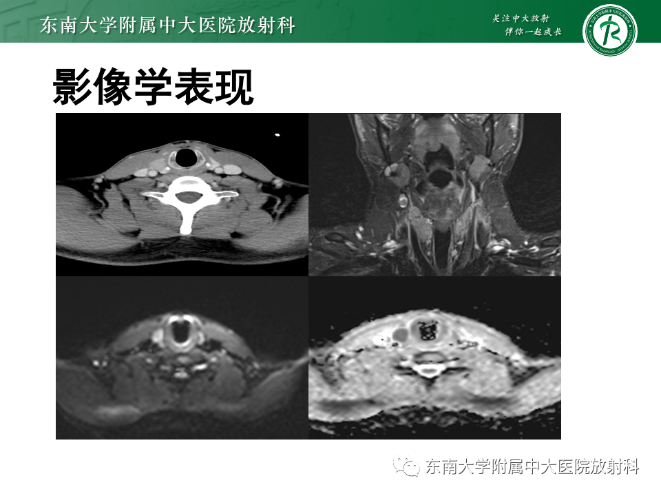 影像PPT - 【PPT】甲状腺癌的影像诊断-2