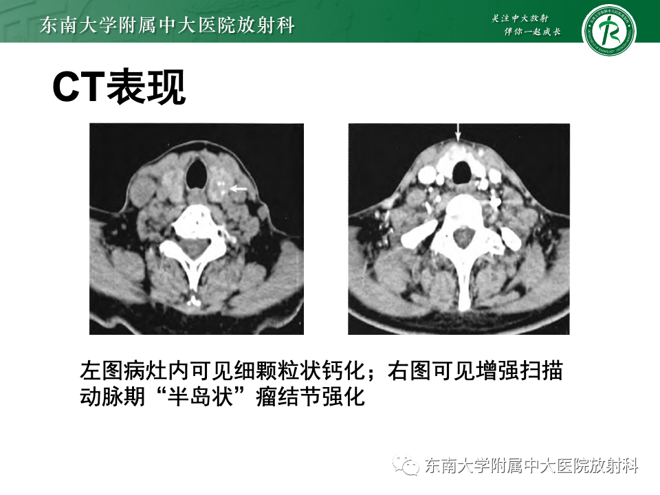 影像PPT - 【PPT】甲状腺癌的影像诊断-16