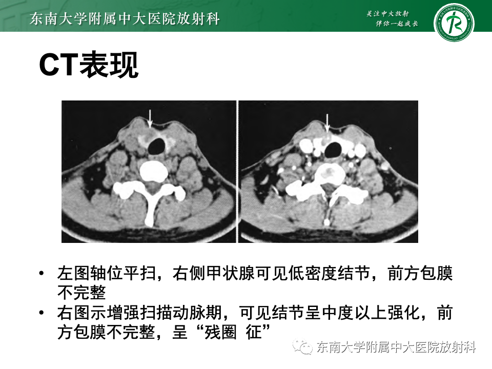 影像PPT - 【PPT】甲状腺癌的影像诊断-17