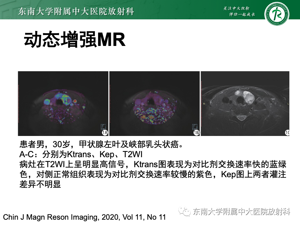 影像PPT - 【PPT】甲状腺癌的影像诊断-19