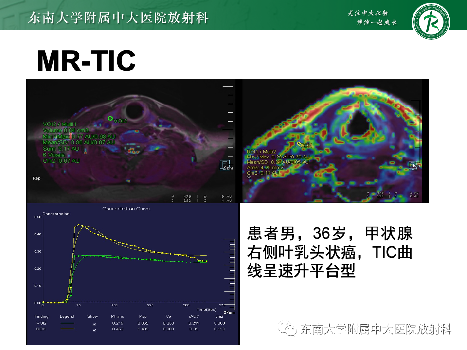 影像PPT - 【PPT】甲状腺癌的影像诊断-21