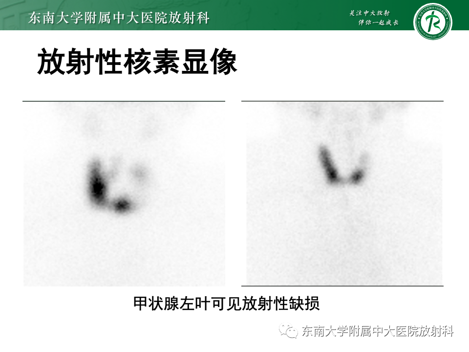 影像PPT - 【PPT】甲状腺癌的影像诊断-23