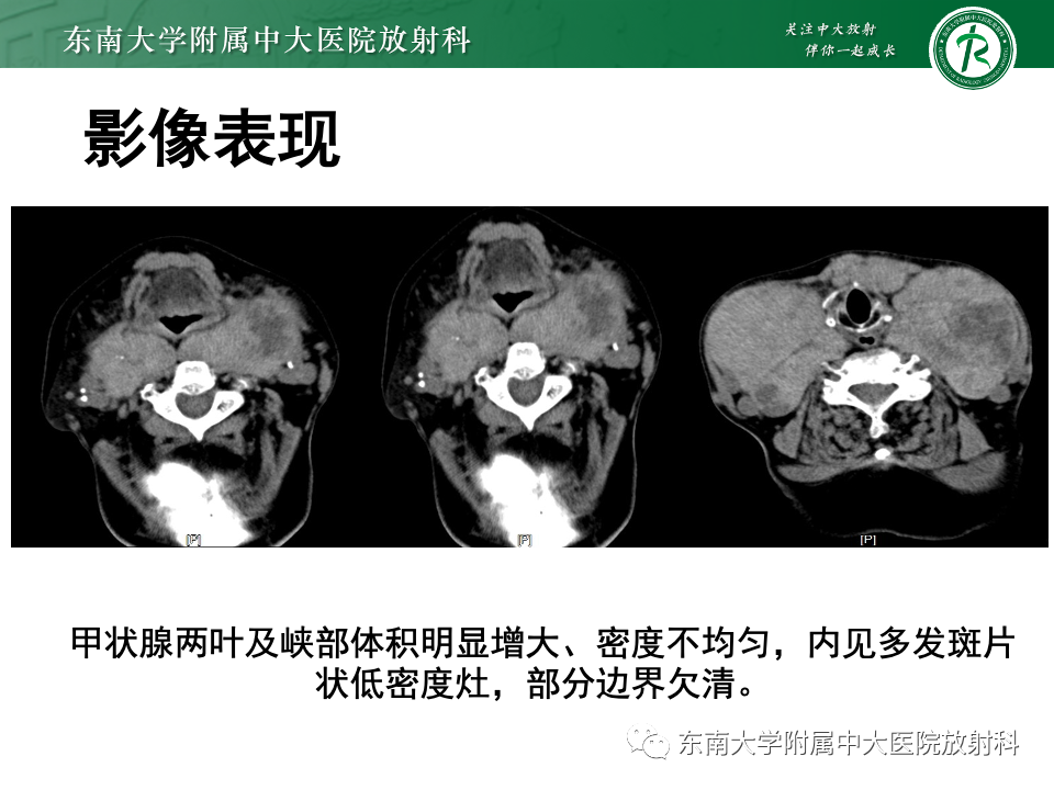 影像PPT - 【PPT】甲状腺癌的影像诊断-26